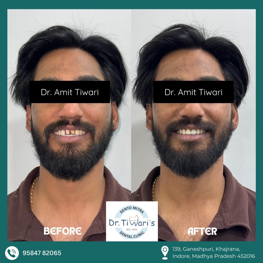 Front Teeth Alignment – Clinical Comparison