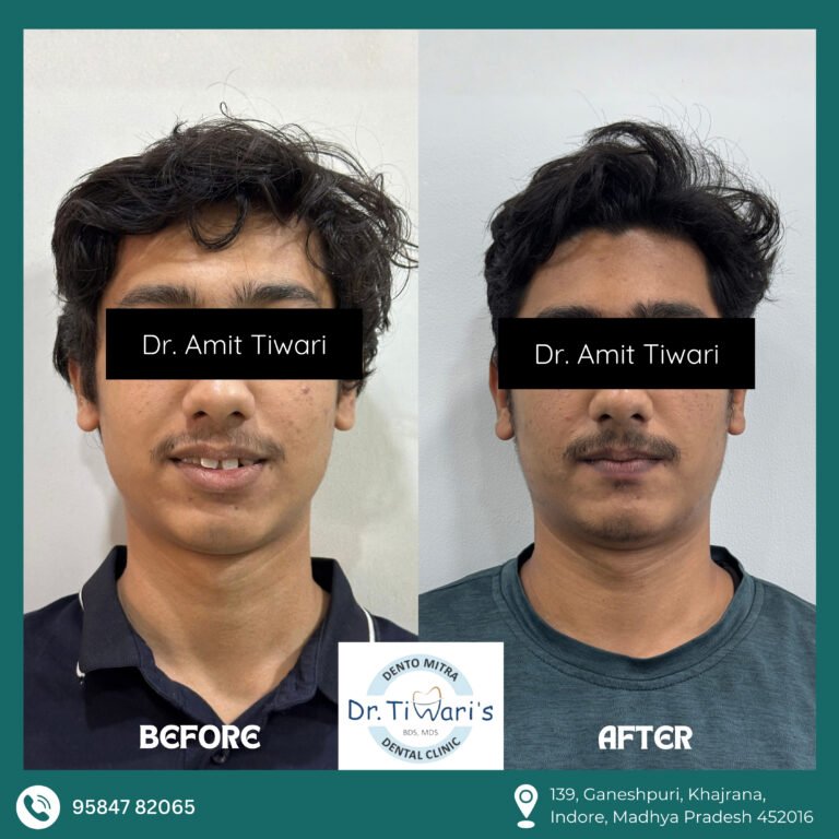 Case 001 – Dental Alignment Transformation