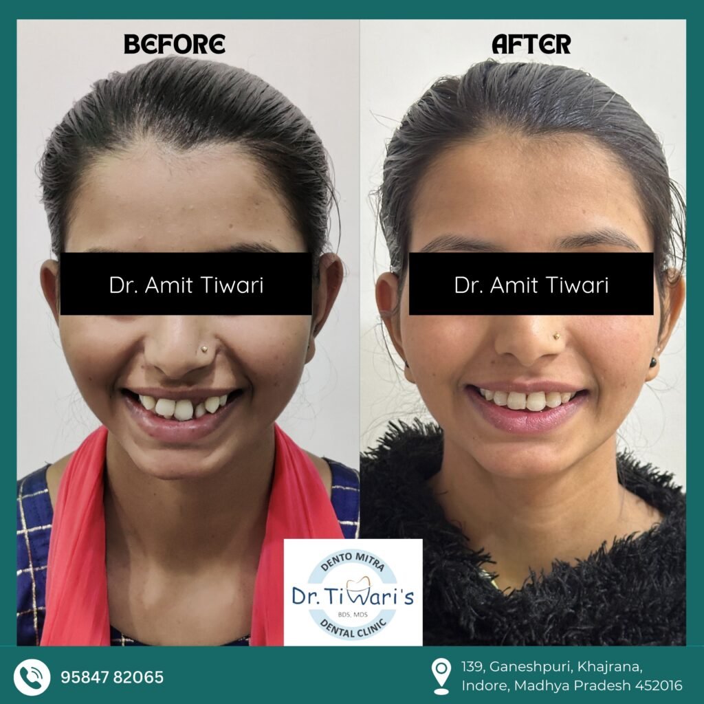 CASE-005 Front Smile and Teeth Alignment Comparison