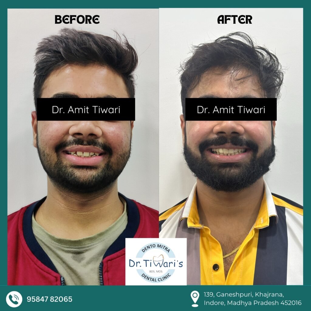 CASE-012 Teeth Alignment and Bite Relationship Transformation